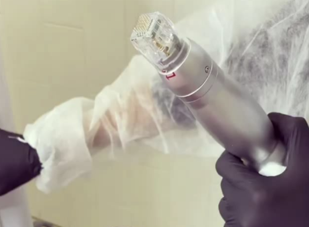 Uncover the Mystery to a Sleek, Taut Neck with RF Microneedling