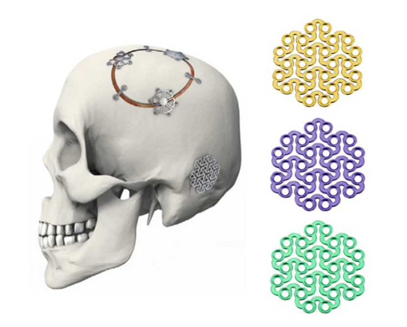 minimally invasive titanium mesh for cranial repair-2