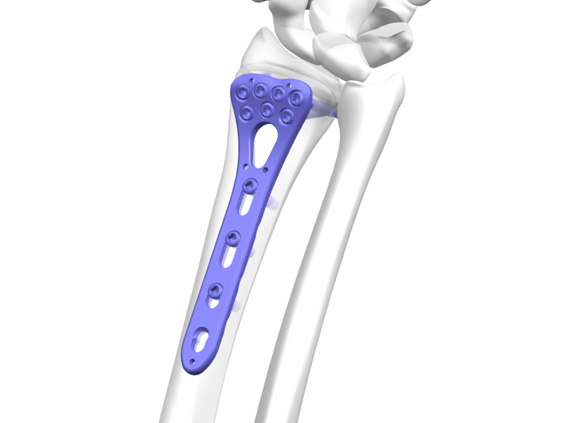 Distal radius locking plates in orthopedic implants