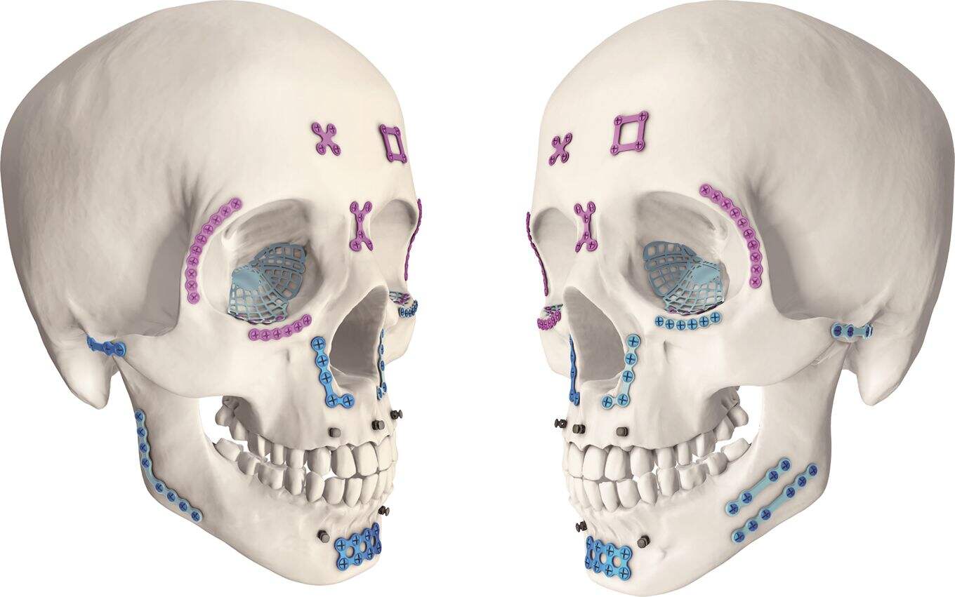 The Advantages of Premold Titanium Mesh in cranioplasty surgery