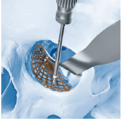 customization pre shaped orbital floor plate type lii-2