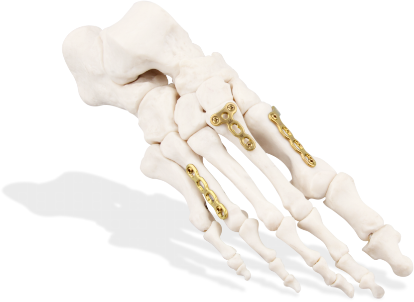 24mm titanium foot mini locking plate system-2