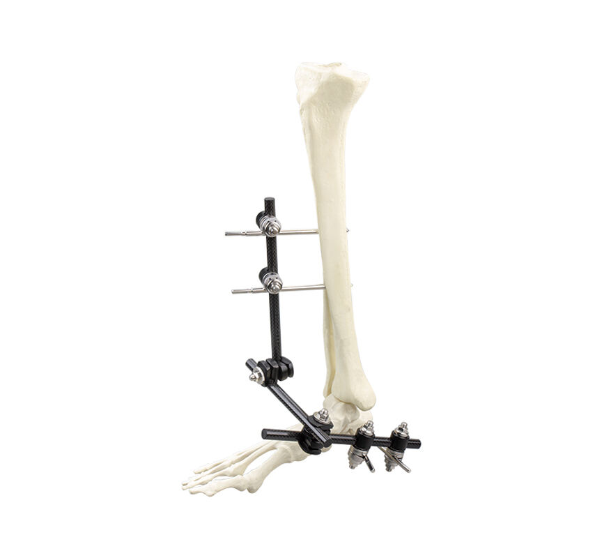 Φ11.0 Series External Fixation Fixator – Ankle Bridge Frame