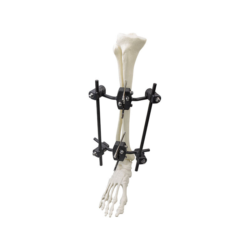 Φ8.0 Series External Fixation Fixator – Tibiaaxis Unilateral Frame