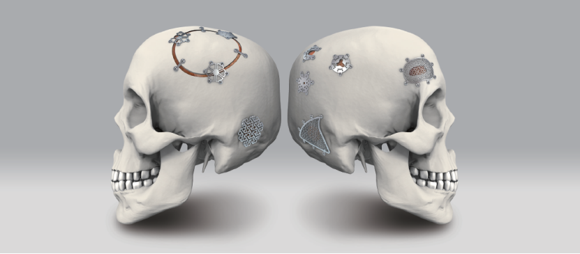 neurosurgery implant cranial interlink plate  temporal fossa interlink plate-3