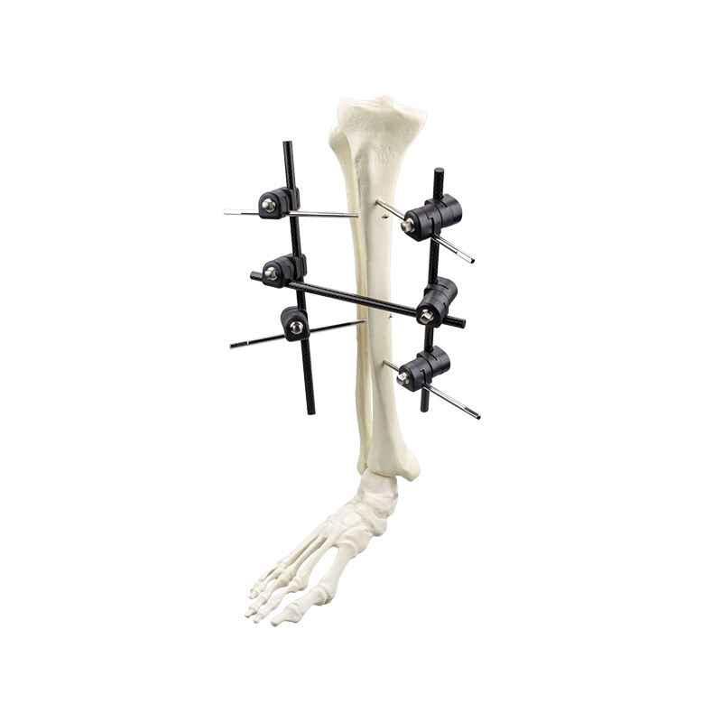 Φ8.0 Series External Fixation Fixator – Tibia Frame