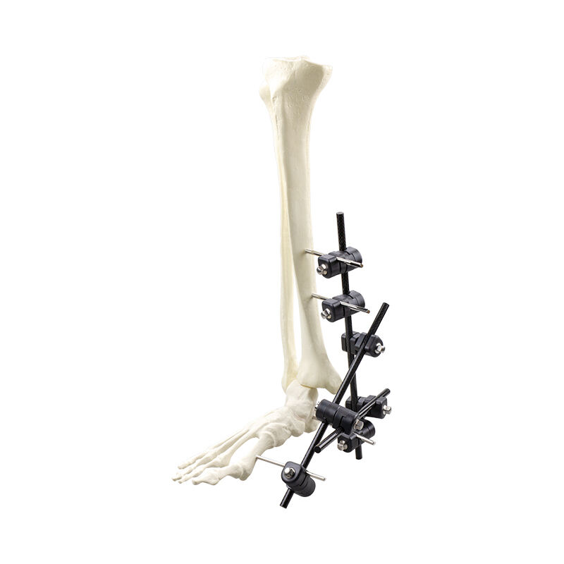 Φ8.0 Series External Fixation Fixator – Ankle Stabilization Frame