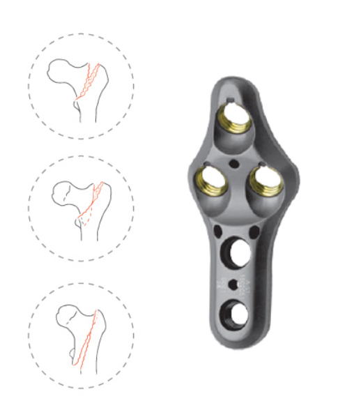 multi axial neck of femur locking plate  type393-2