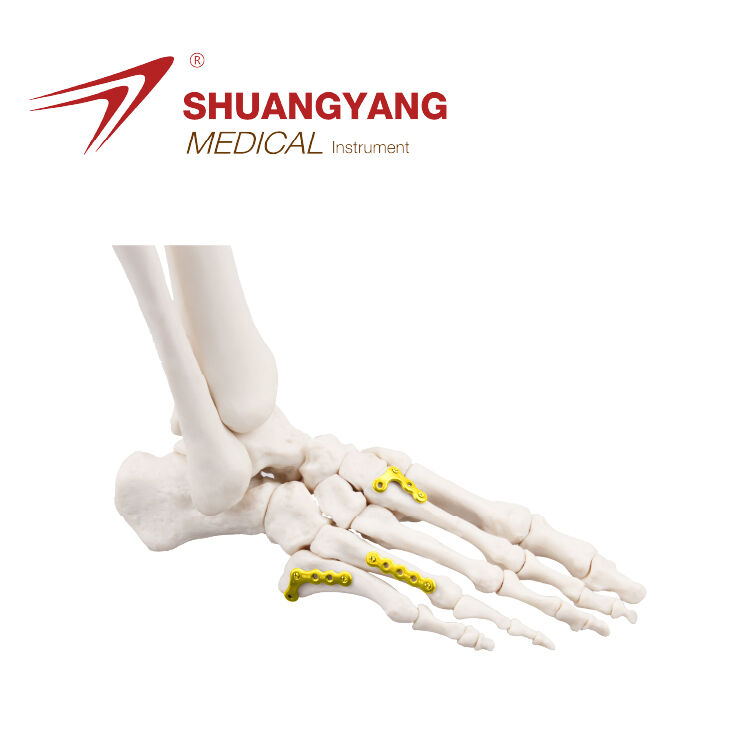 2.4mm Titanium Foot Mini Locking Plate System