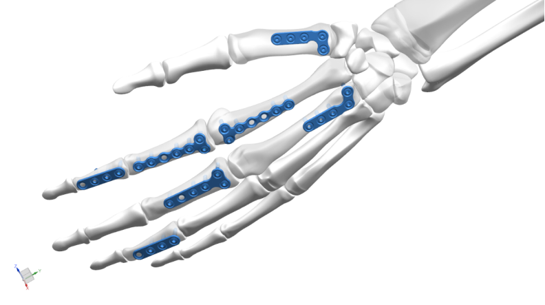 20mm titanium hand mini locking plate system-2