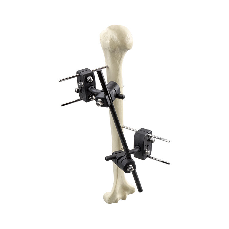 Φ8.0 Series External Fixation Fixator – Humerus Backbone Frame