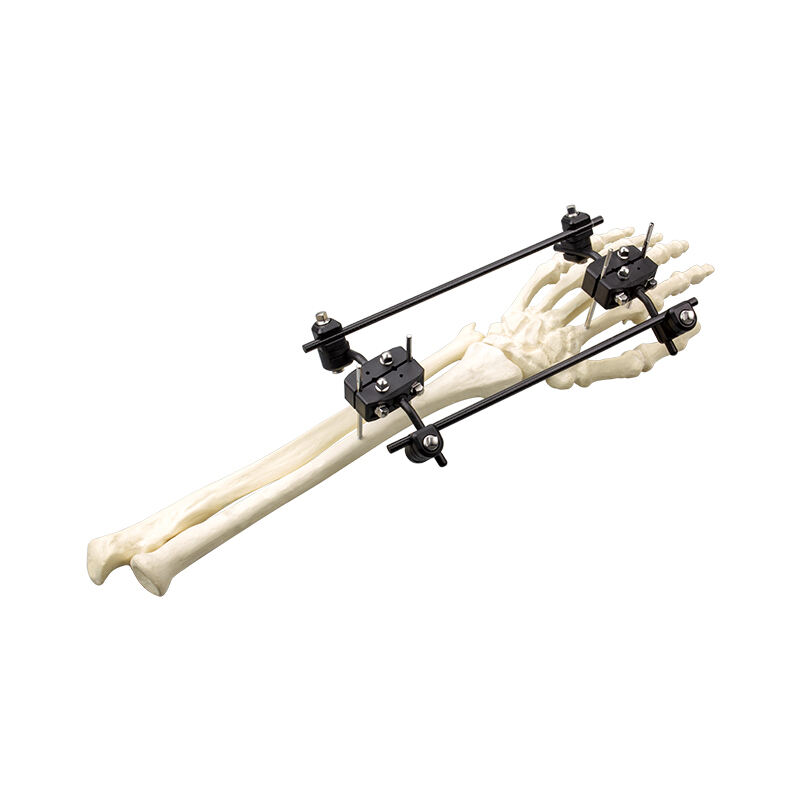 Φ5.0 Series External Fixation Fixator – Radius Cross-Articular Frame