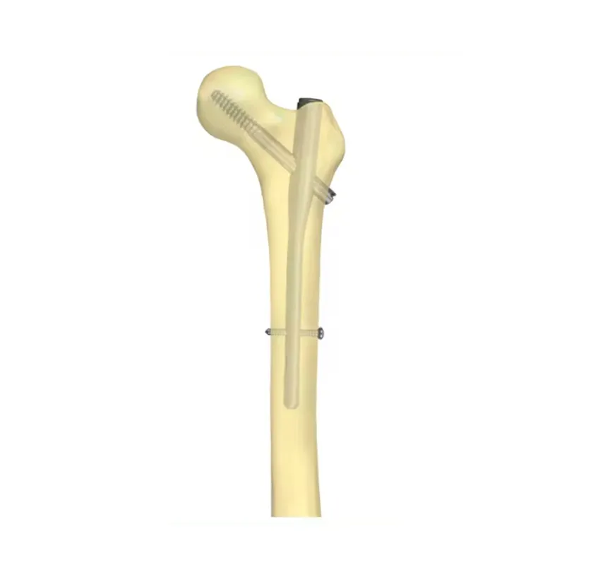 Pourquoi les chirurgiens préfèrent les clous intramédullaires en titane en orthopédie moderne