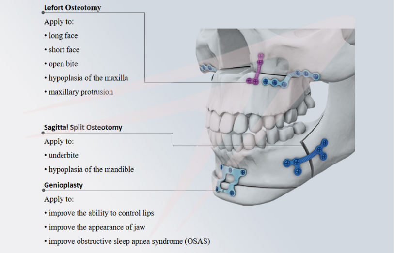 10mm thickness orthognathic series anatomical l plate titanium maxillofacial plate6 holes-2