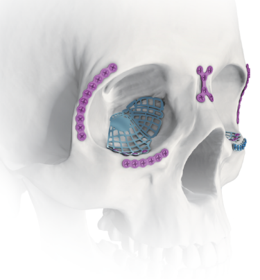 anatomical orbital floor plate-1