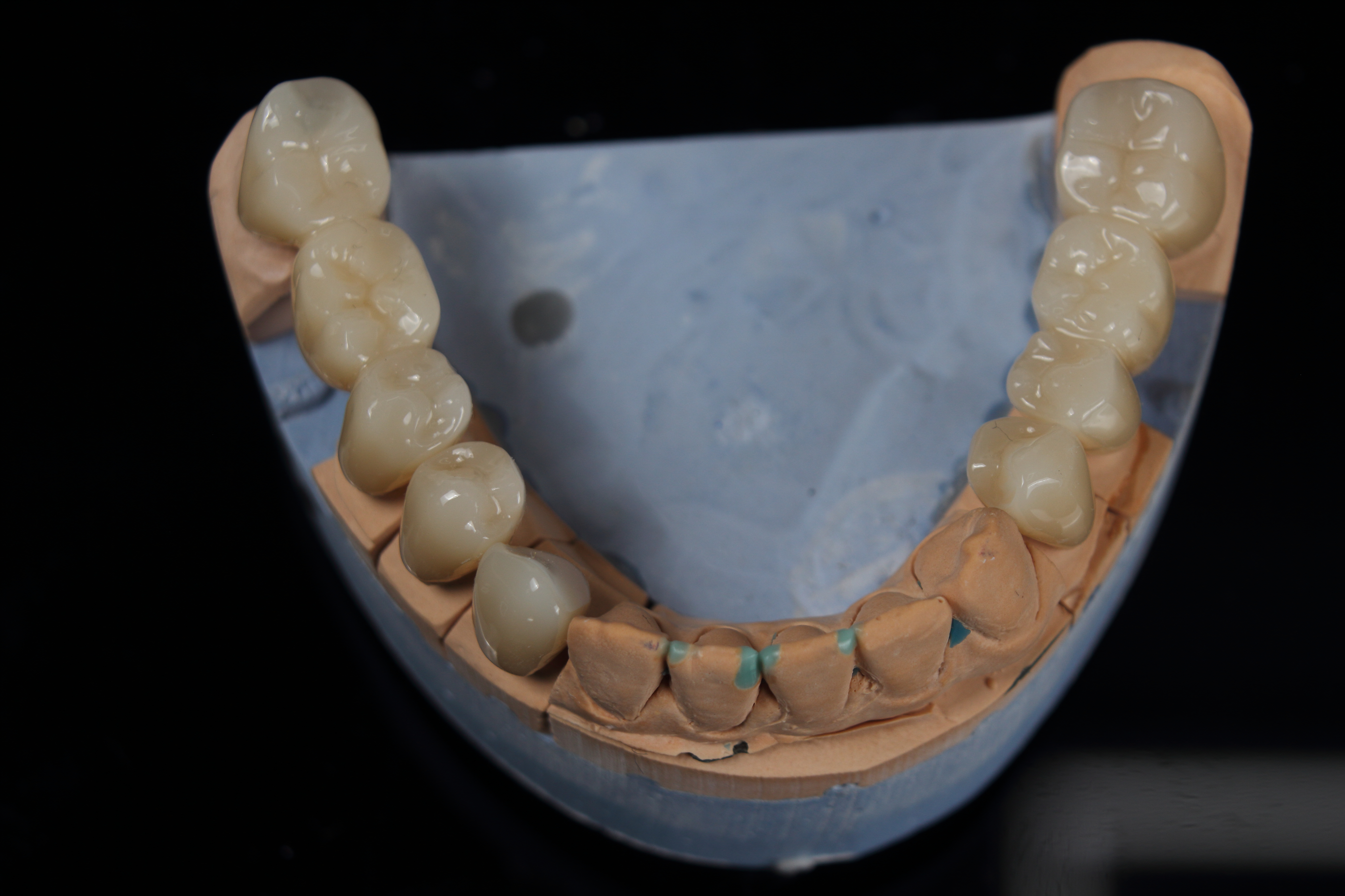 Unmatched Strength and Aesthetics in Zirconia Full Arch Bridges