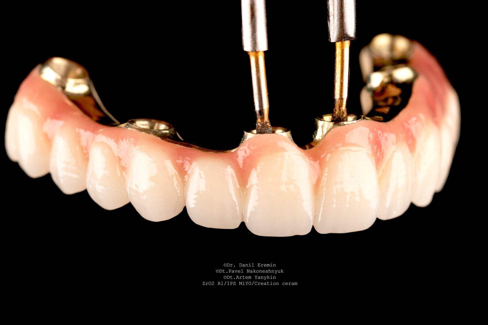 Unmatched Strength and Aesthetics in Teeth Zirconia Bridges