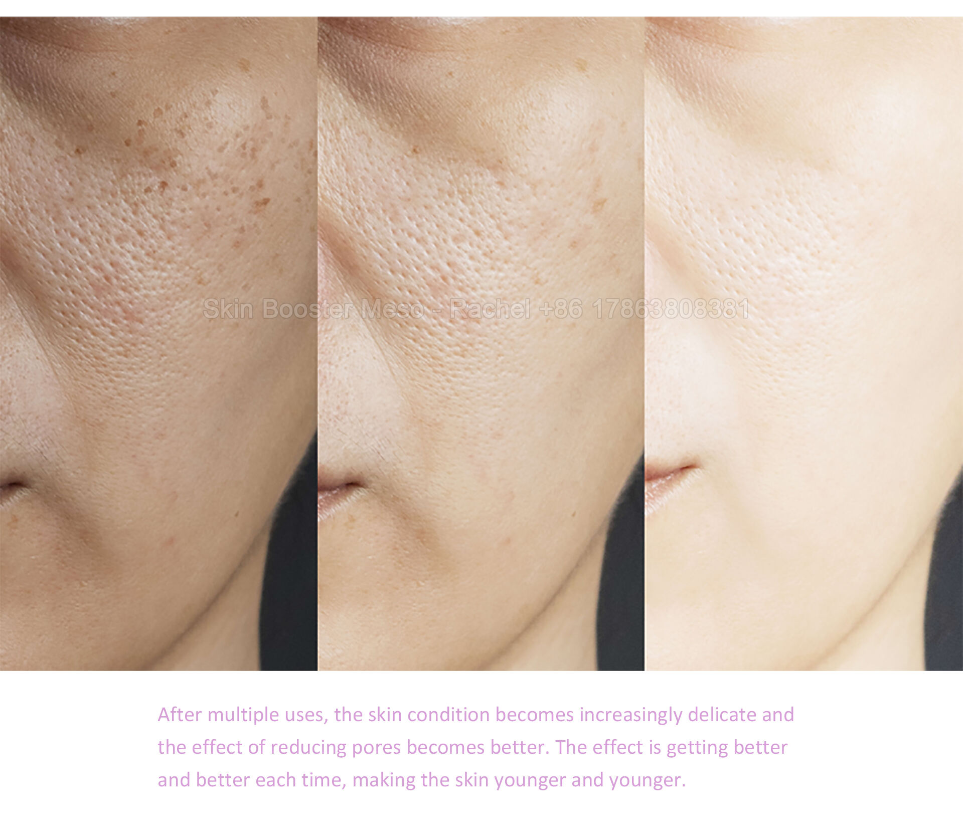 skin-booster---PSD_05.jpg