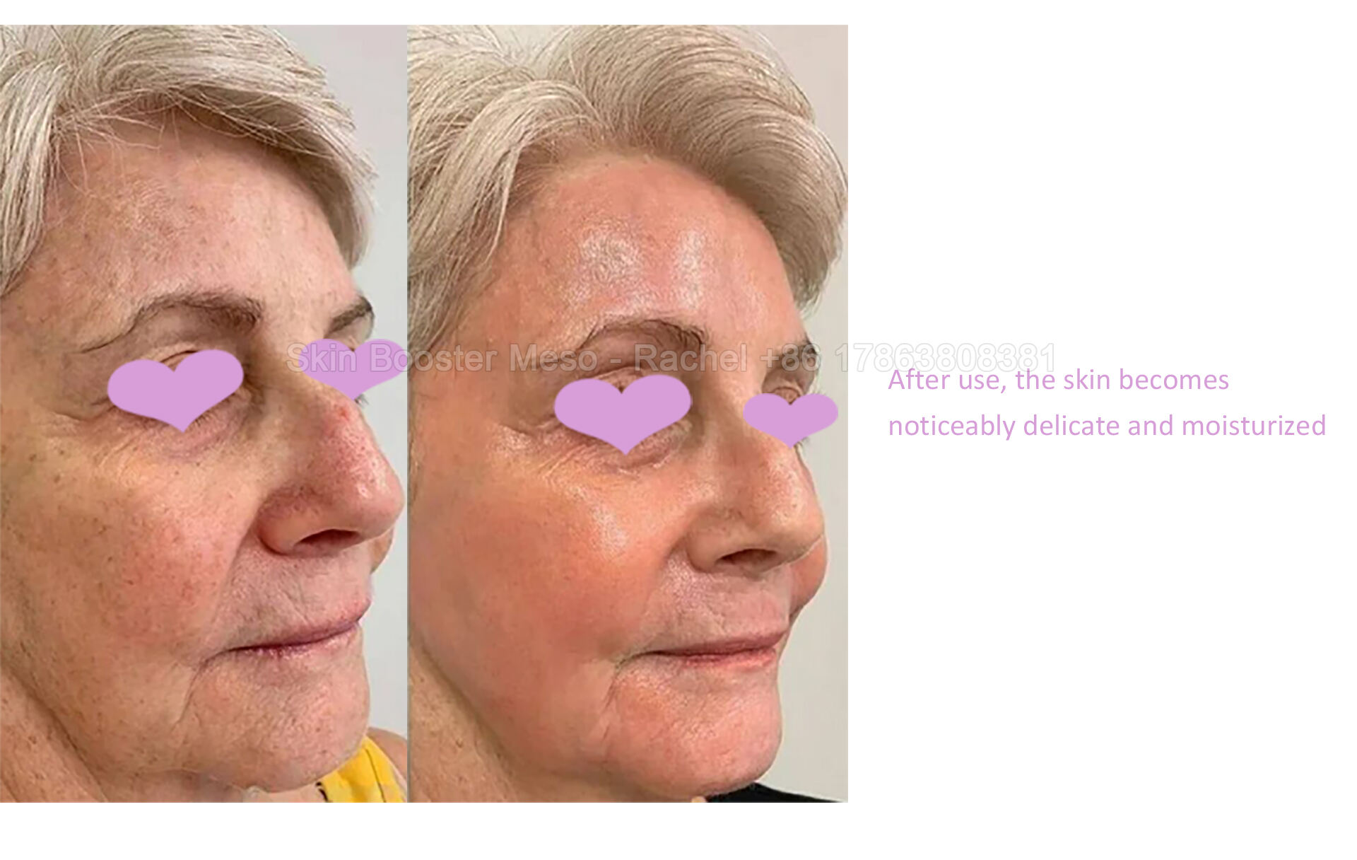 skin-booster---PSD_06.jpg
