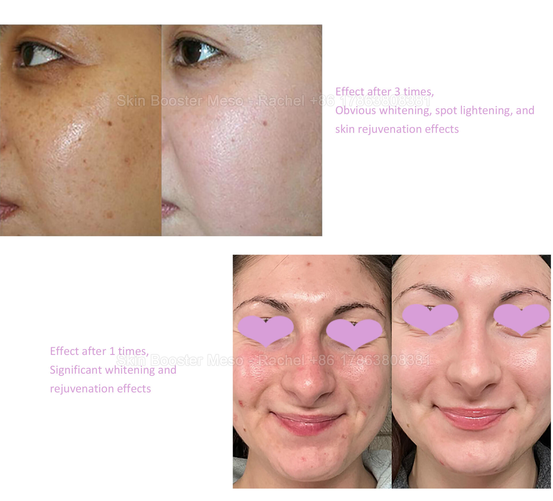 skin-booster---PSD_04.jpg