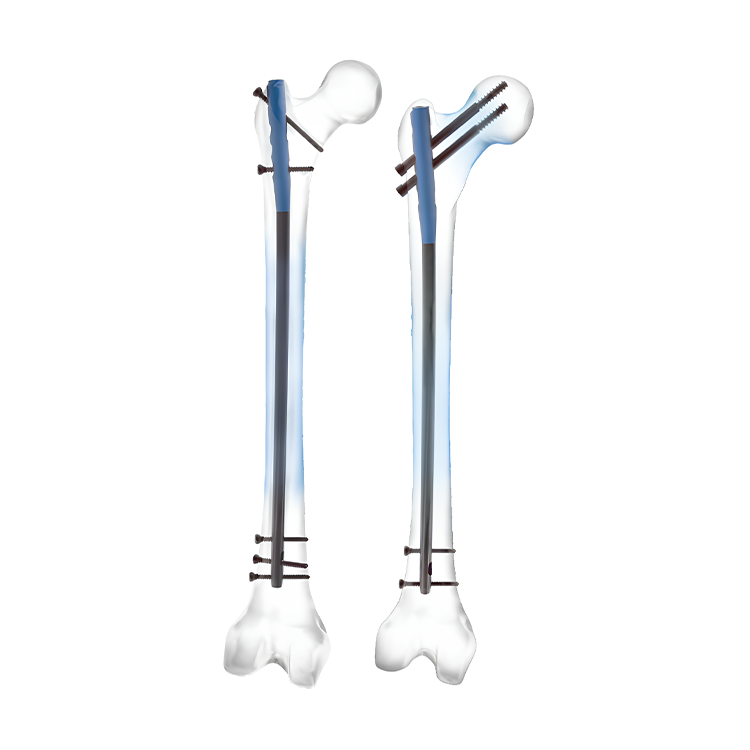 Expert Femoral Intramedullary Nail