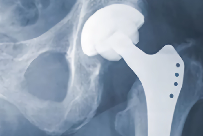 Modern Hip Replacement