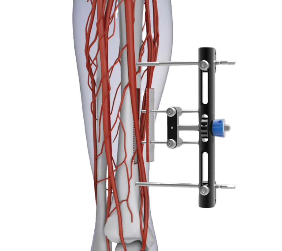 Wishbone Transverse Bone Transport System