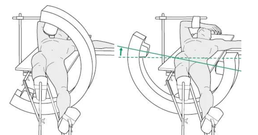 Femoral Intramedullary Nailing: Key Surgical Principles
