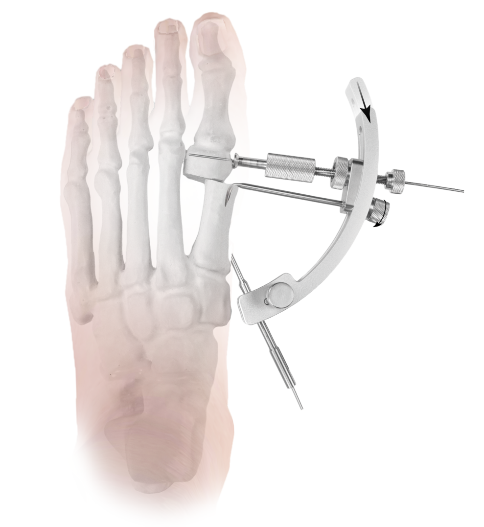 Hallux Valgus Correction Guiding Tools