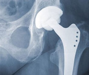 2-Total-Hip-Replacement-1.png