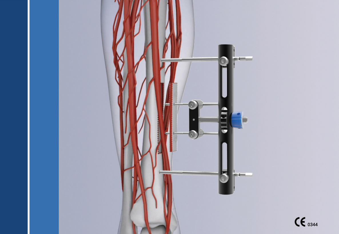 Wishbone Transverse Bone Transport System manufacture