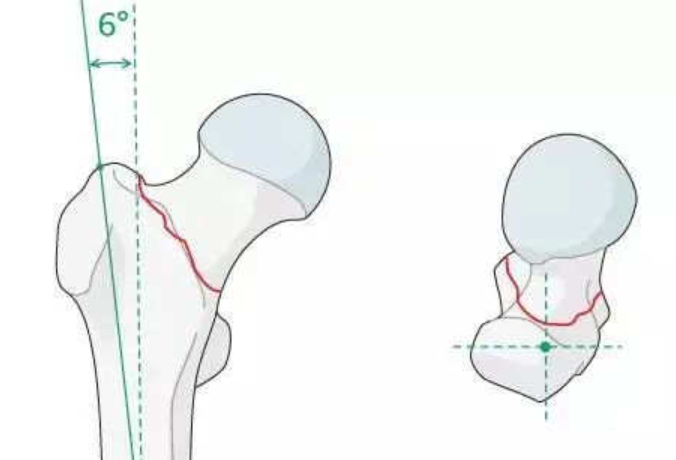 Femoral Intramedullary Nailing: Key Surgical Principles