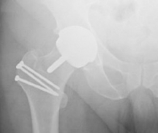 2-Total-Hip-Replacement-3.png