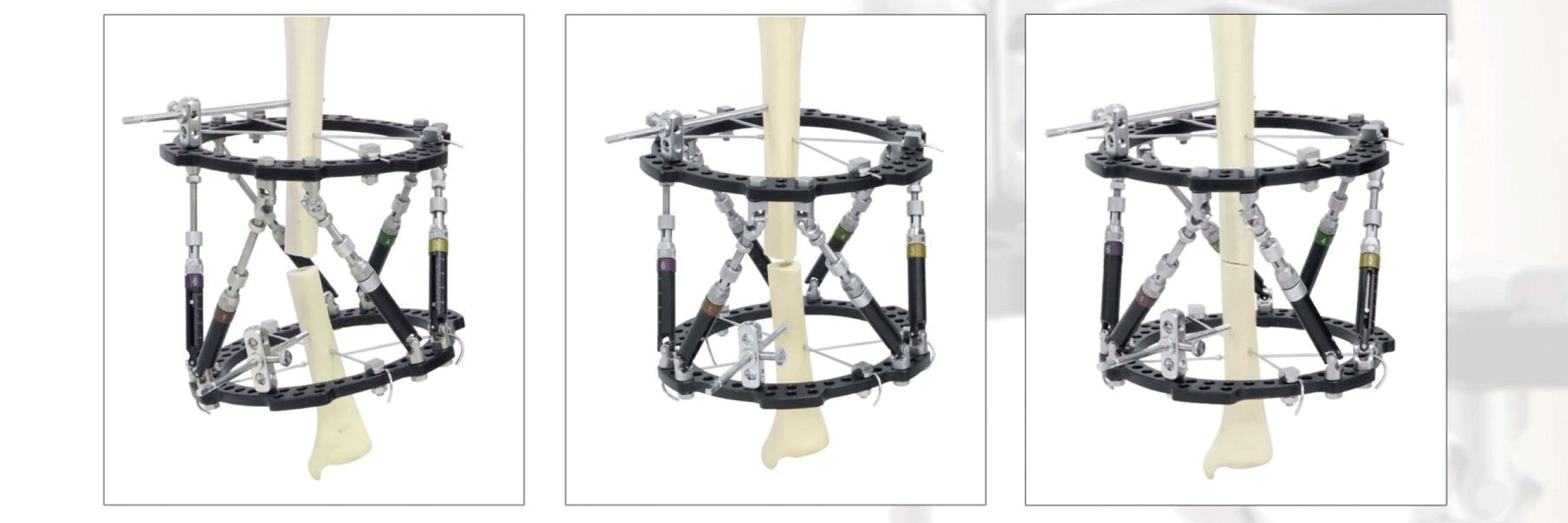 Hexapod-Digital-External-Fixation-Frame_04.png
