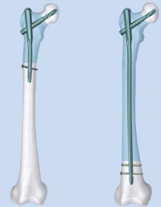 Femoral Intramedullary Nailing: Key Surgical Principles