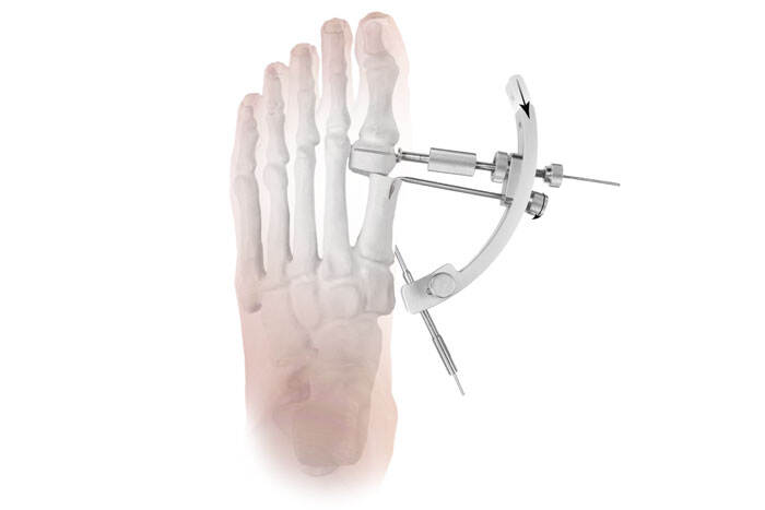 Hallux Valgus Correction Guiding Tools