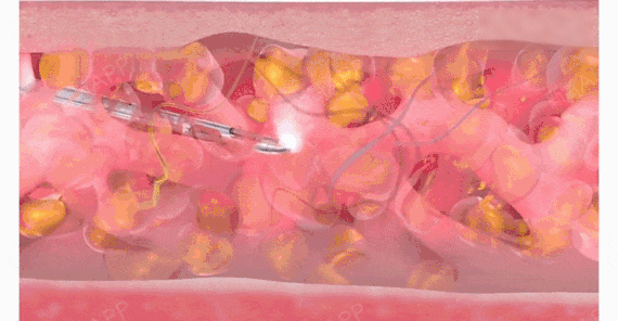 Hyperbaric Oxygen Promotes Rapid Recovery After Plastic Surgery