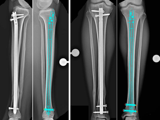 【Kirurško predavanje】Standardizirani operativni vodnik za intramedularno klinjenje (IMN) na stegneni kosti: od izbire dostopa do izogibanja ujetnicam
