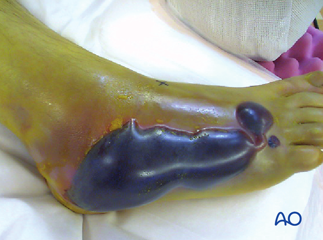 The Extended Lateral Approach to the Calcaneus – The Large L-Shaped Incision