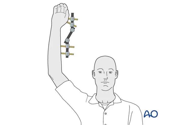 Transarticular External Fixation for Distal Radius Fractures