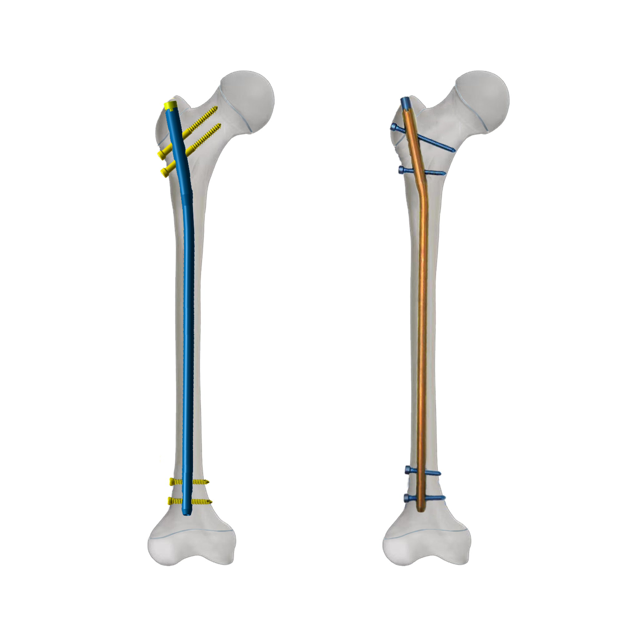 What is the growth trend of the pediatric orthopedic implant market? What is the future development outlook?