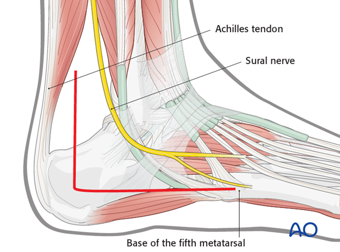 The Extended Lateral Approach to the Calcaneus – The Large L-Shaped Incision