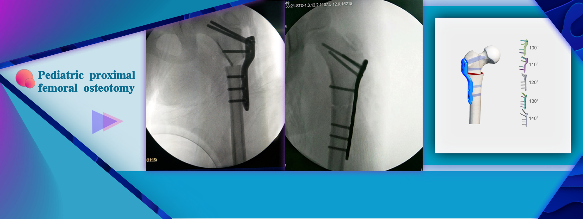 Pediatric Proximal Femoral Osteotomy