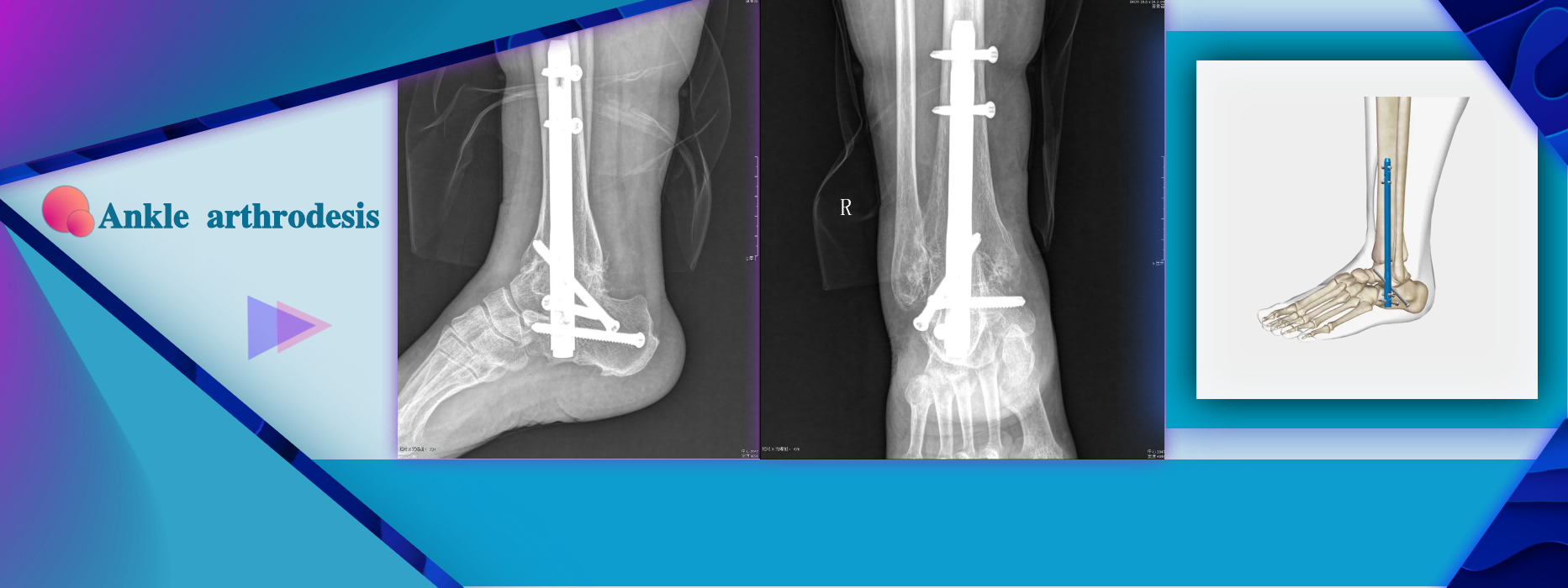Ankle Arthrodesis