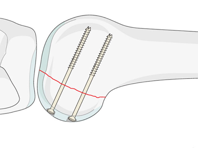 Open Reduction and Internal Fixation with Plate for Hoffa Fracture