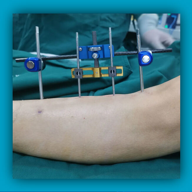 Lateral Tibial Bone Transfer Surgery
