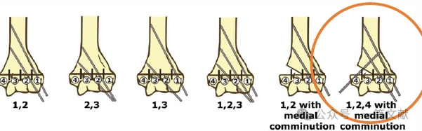 Treatment of Pediatric Supracondylar Humerus Fractures