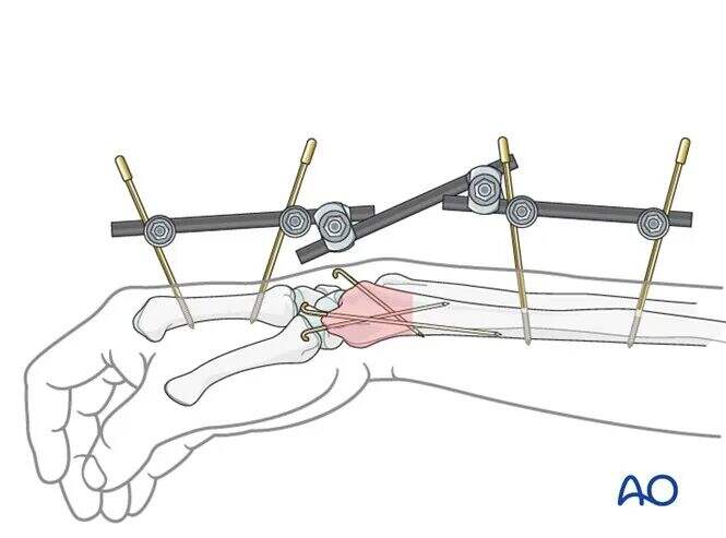 Transarticular External Fixation for Distal Radius Fractures