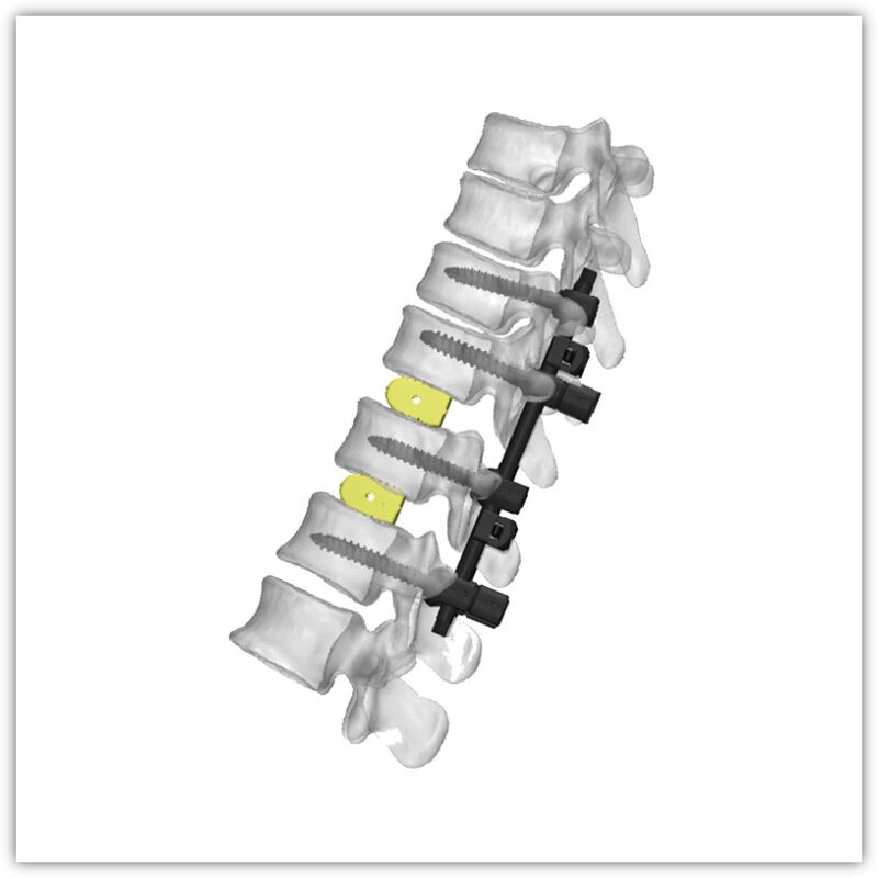 https://shopcdnpro.grainajz.com/category/83036/2966/0fbf9e0eb83f77190ff3c13a761f0d5a/Spinal%20System.jpg