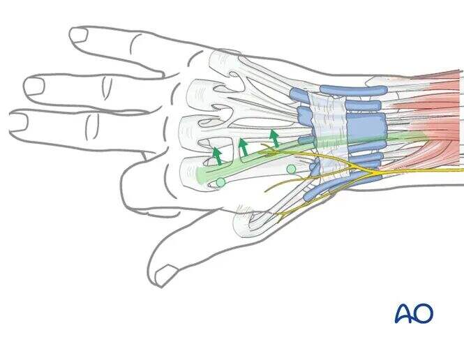 Transarticular External Fixation for Distal Radius Fractures